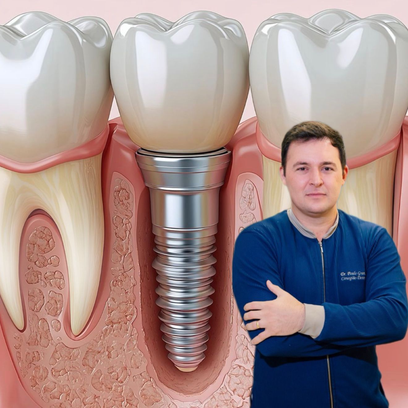 foto de implante dentario e dr paulo grandal