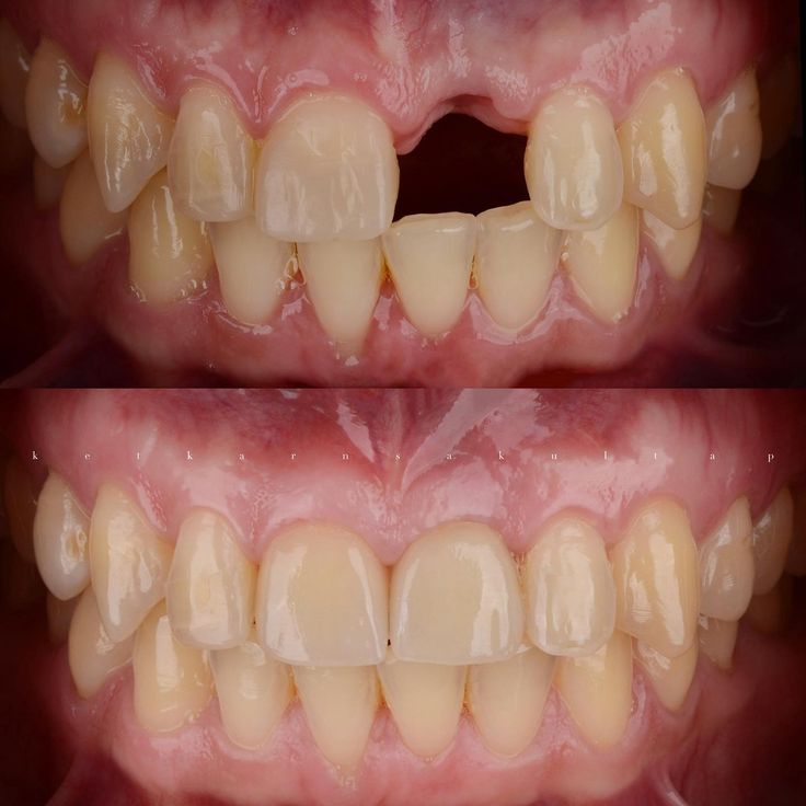 perda de um dente da frente